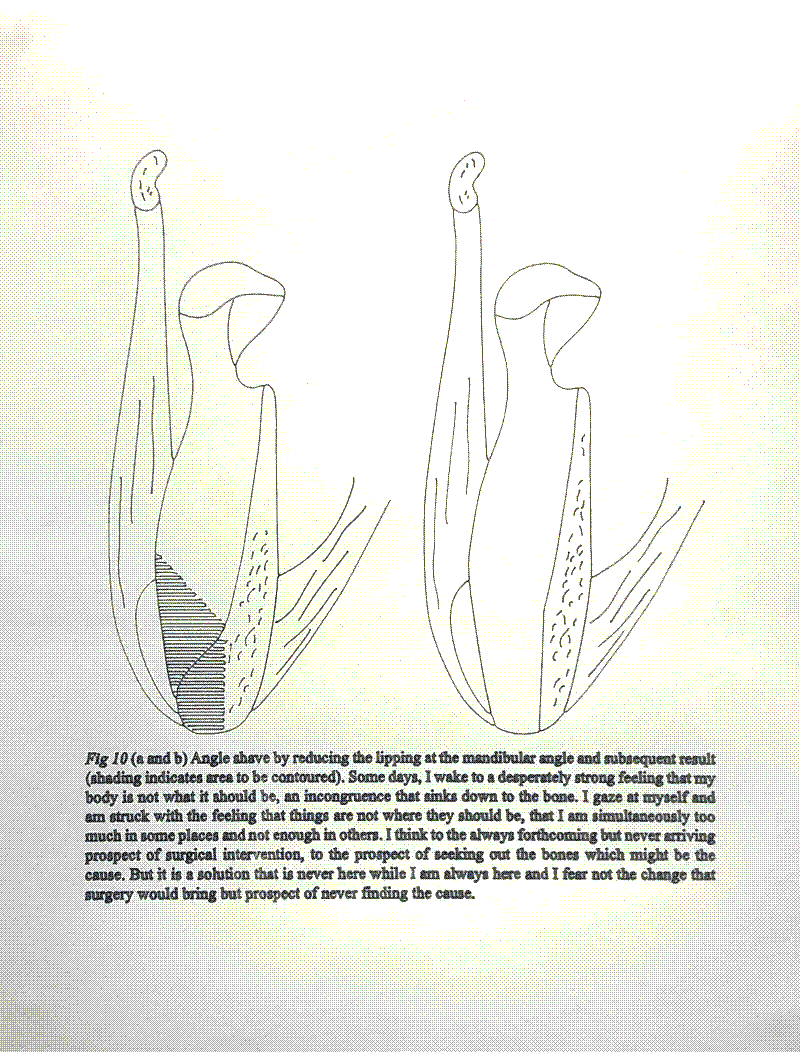 Black and white image of a medical diagram with text caption.